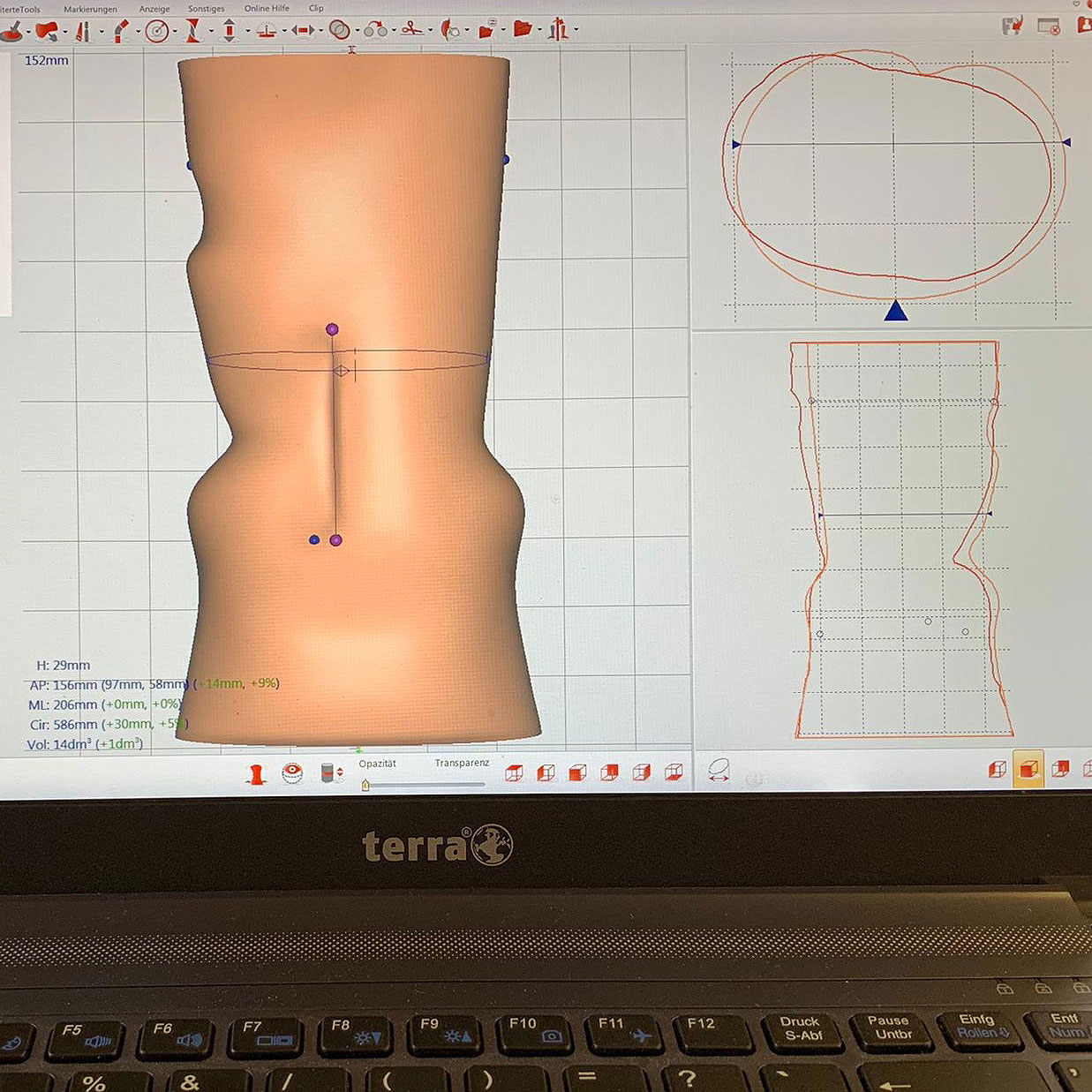 Skoliosekorsett: Bearbeitung der 3D-Daten am Computer