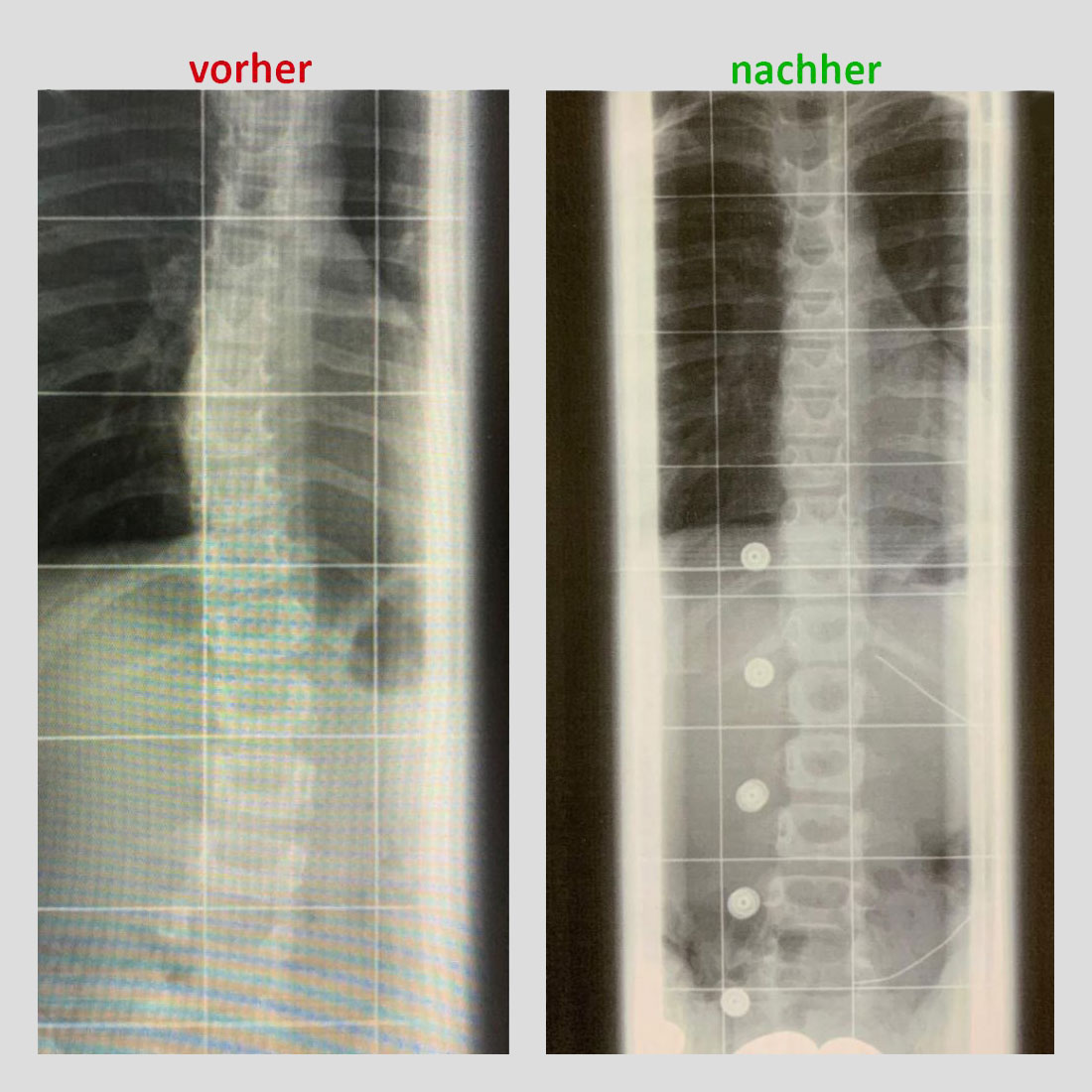 Skoliosekorsett: Korrektur vorher / nachher Skoliosekorsett: Korrektur vorher / nachher