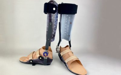 Spitzfuß-Versorgung